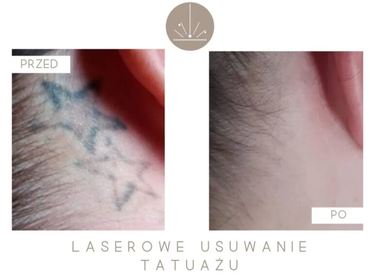 Read more about the article Skuteczny laser do usuwania tatuaży i makijaży permanentnych